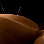 Acupuncture treatment at Saltuary